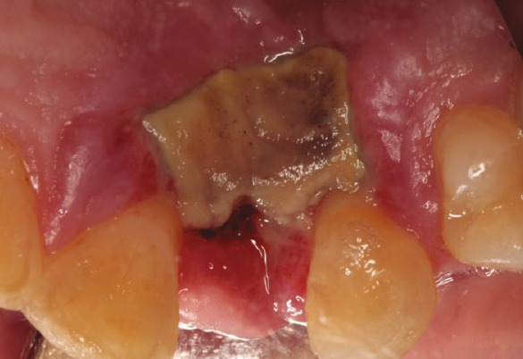 Palatal mucosa necrosis after implant removal