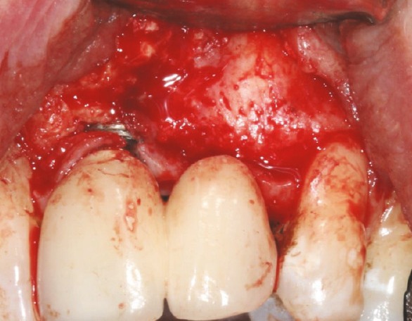 Labial flap reflected, showing implant surface uncovered by bone
