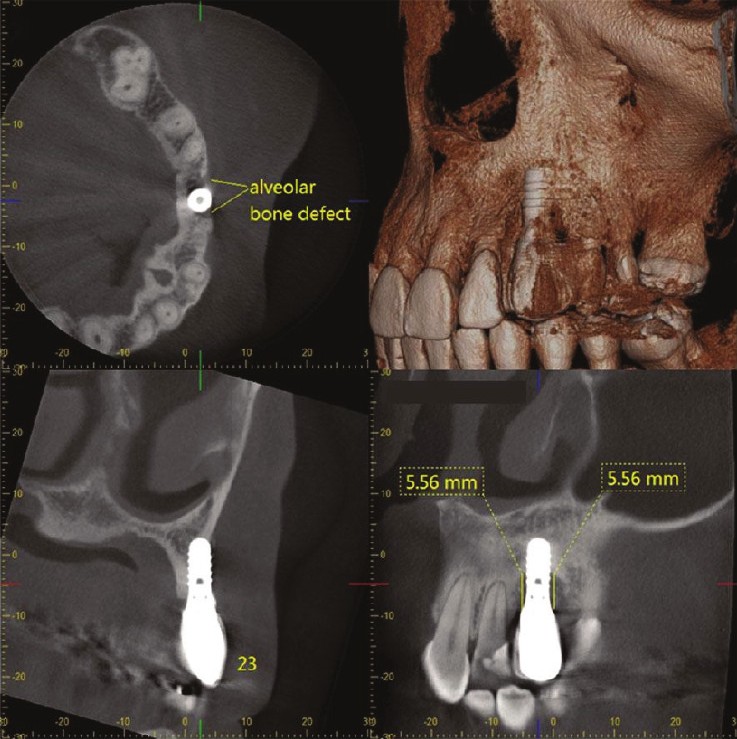 CBCT showing labial bony dehiscence beside the implant