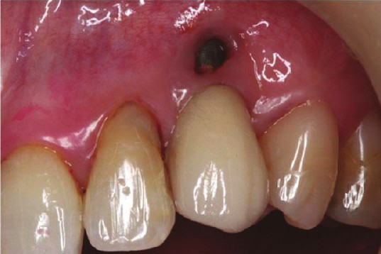 Soft tissue fenestration at the labial site of a maxillary canine implant