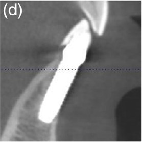 Cross-sectional view showing deficient buccal bone