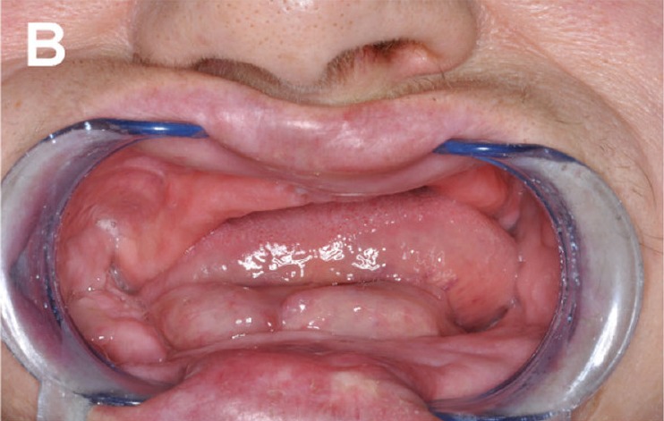 Preoperative intraoral view of an extremely atrophic mandible with no residual ridge