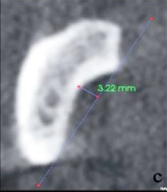 Cross-sectional CBCT showing a deep submandibular fossa, type III