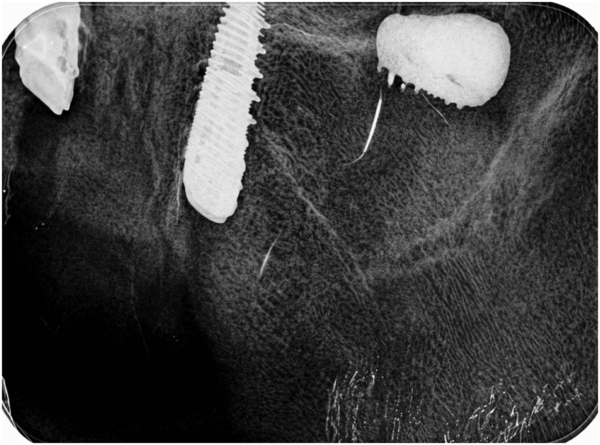 Periapical radiograph of an implant displaced into the left maxillary sinus