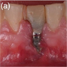 Implant in ungrafted narrow bone with the buccal surface exposed
