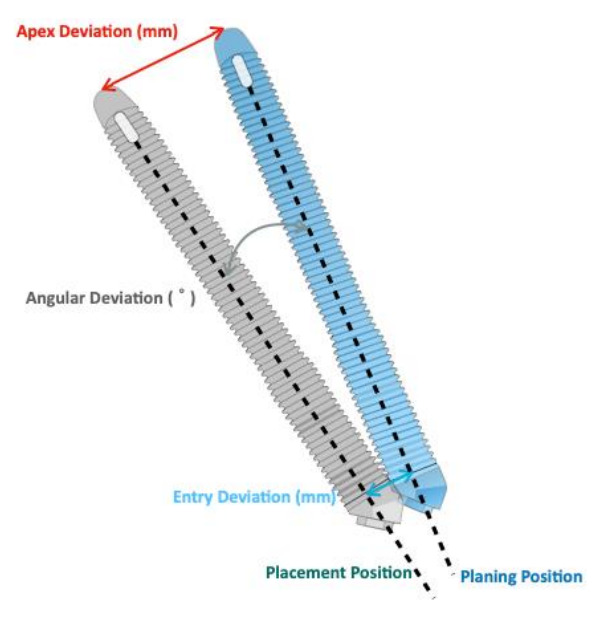 Planned versus placed implant position: entry, apex and angular deviation