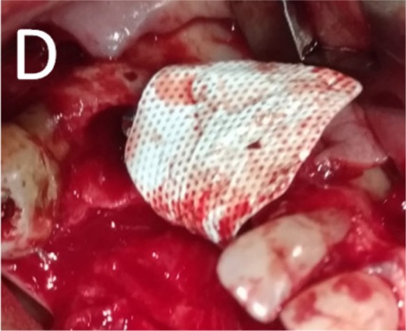 Insertion of the graft