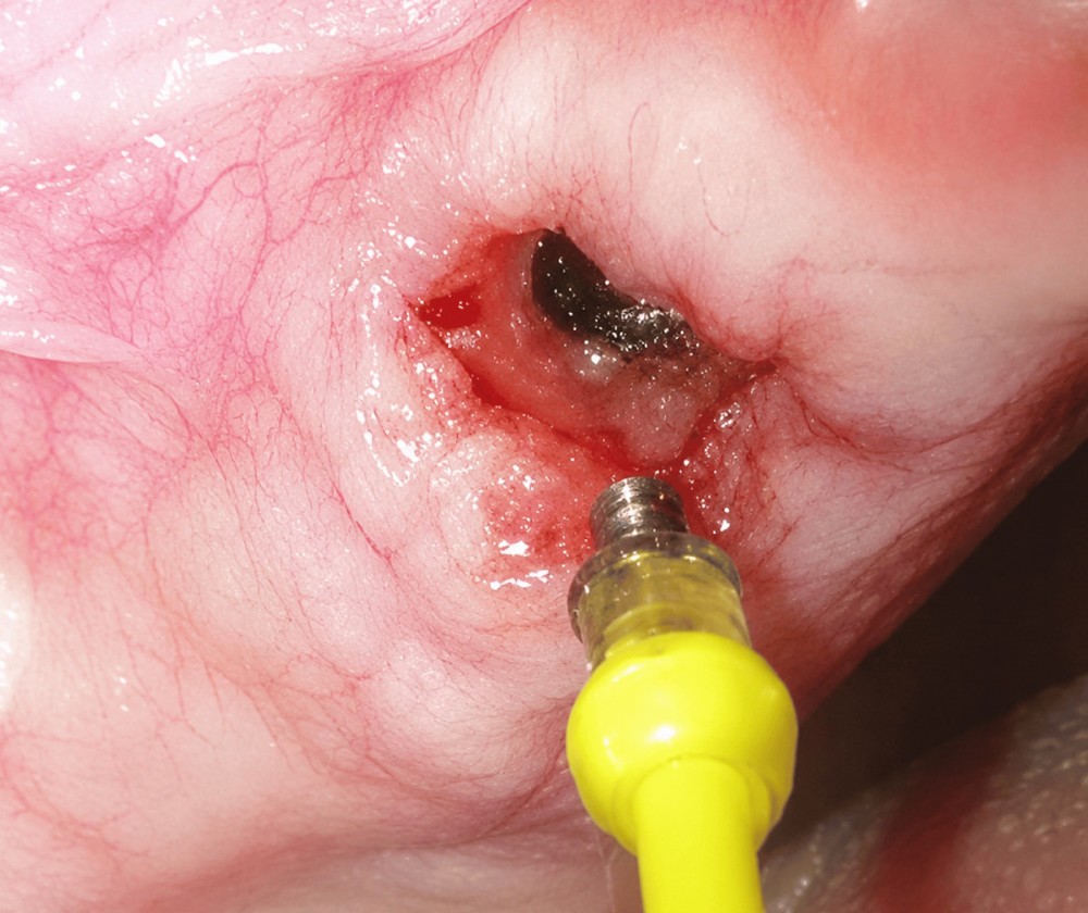 The retrieved fractured screw fragment lifted from the implant connection on an adhesive-tipped applicator