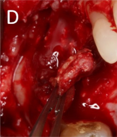 Granulomatous tissue removed from under the membrane