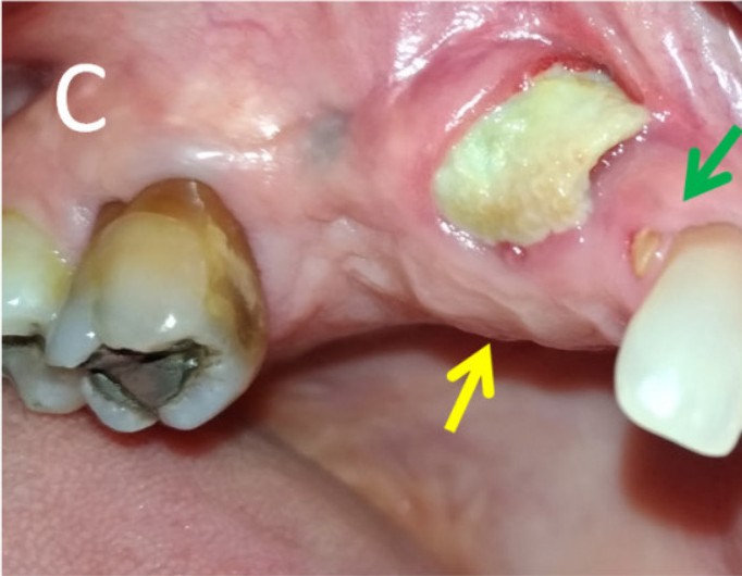 Further increase in the exposed area at six months