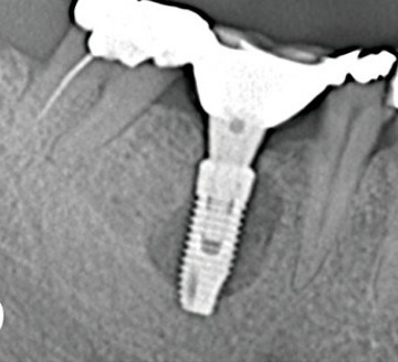 The same implant 26 months later with an ovoid bone lucency around the body