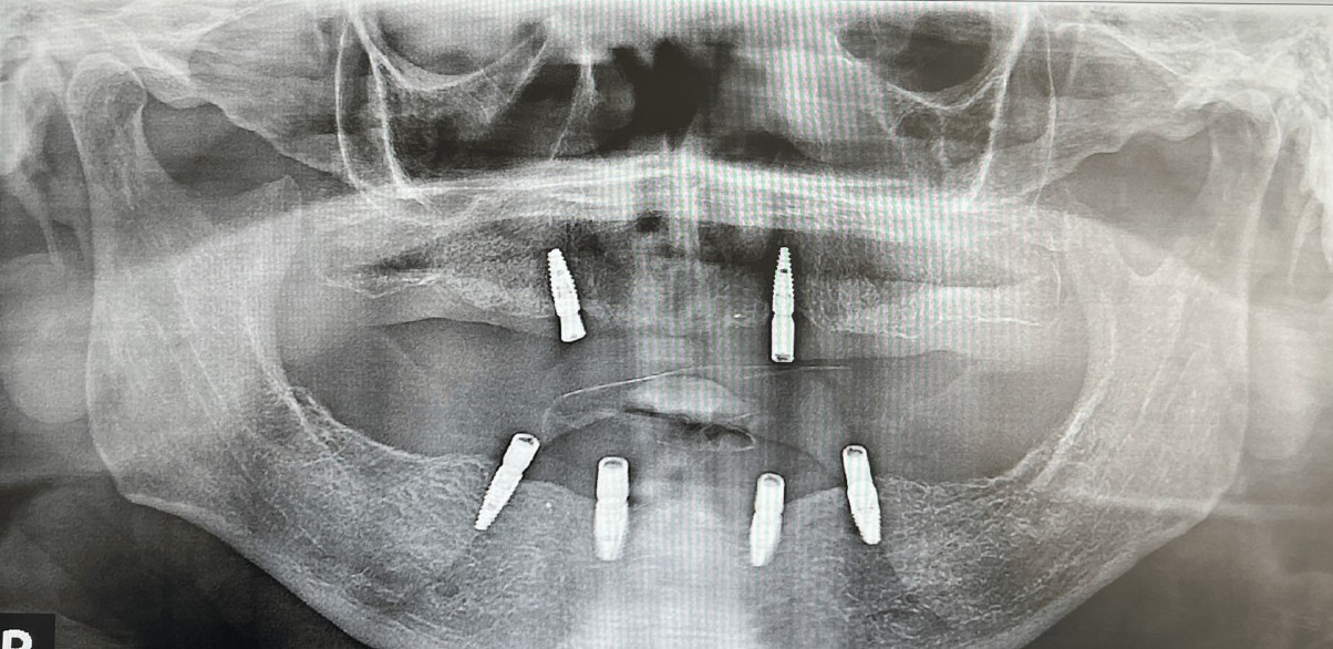 Panoramic radiograph showing two maxillary and four mandibular implants