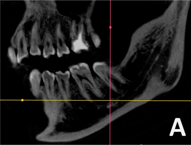 Sagittal CBCT reconstruction of a hemimandible showing the molar teeth