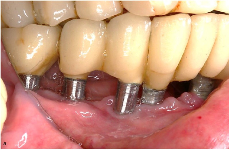 Twelve months after implantoplasty: machined implant bodies emerging through the mucosa
