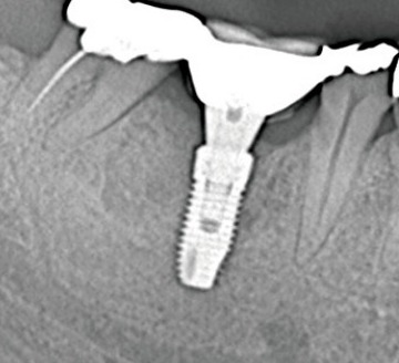 Radiograph of a mandibular implant at prosthesis delivery, no abnormality